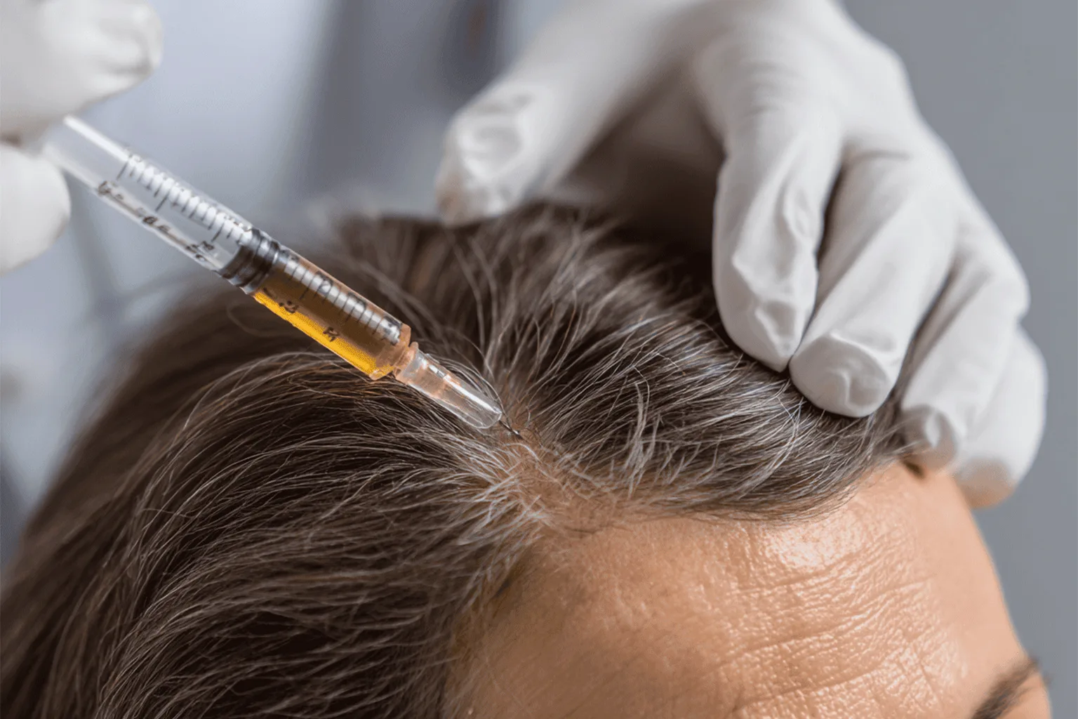 SVF Stem Cell Hair Therapy
